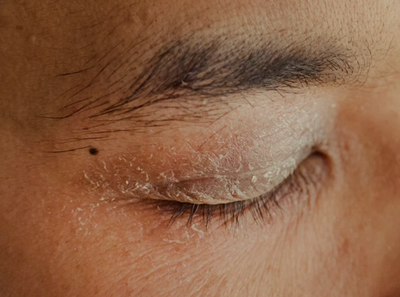 Understanding and Treating Dry Eyelid Skin