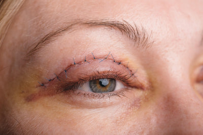 What is Eyelid Surgery?