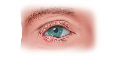What causes styes? | Eye health education 101