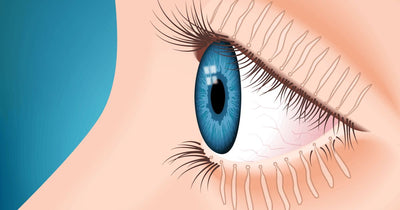 What Is Meibomian Gland Dysfunction?