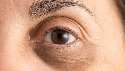 10 Natural Ways to Get Rid of Bags Under The Eyes